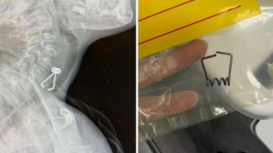 مشبك غسيل معدني حاد الجانبين يستنفر الطواقم الطبية في زيڤ